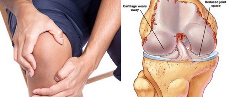 Thoái hóa khớp gối nếu không chữa trị sớm và đúng cách có thể gây biến chứng.