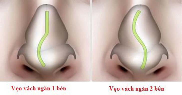 Vẹo vách ngăn là sự biến đổi cấu trúc thực thể.