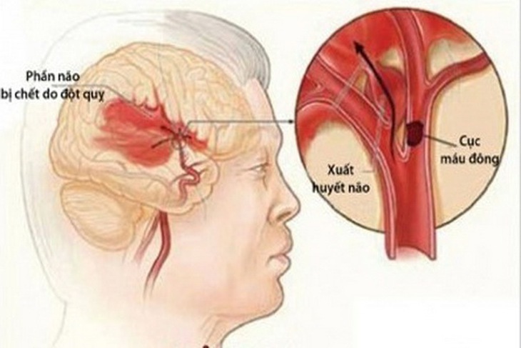Cục máu đông gây đột quỵ não.