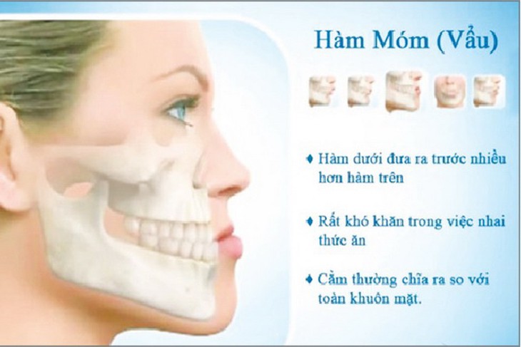 Hình ảnh hàm móm (vẩu hàm dưới).