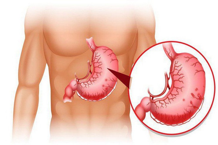 Đau dạ dày - một bệnh dễ mắc ở nam giới tuổi trung niên.