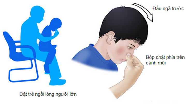 Cách xử trí đúng khi trẻ bị chảy máu cam.