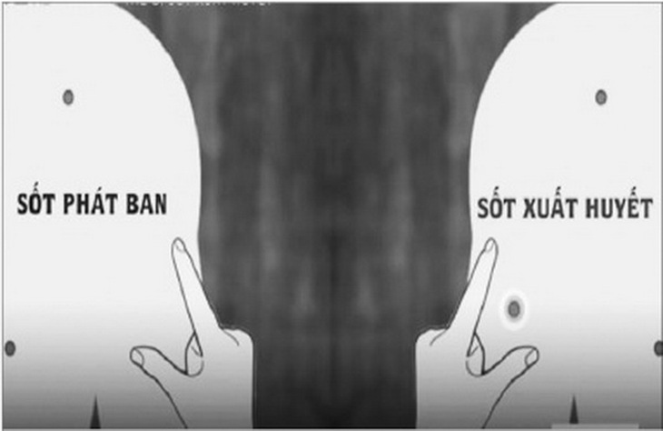 Dùng tay căng vùng da tại nốt phát ban có thể phân biệt sốt xuất huyết và sốt phát ban.