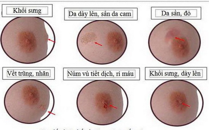 Một số dấu hiệu của ung thư vú.