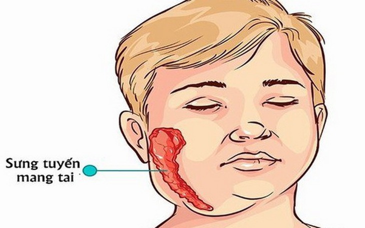 Hình ảnh sưng tuyến mang tai trong bệnh quai bị.