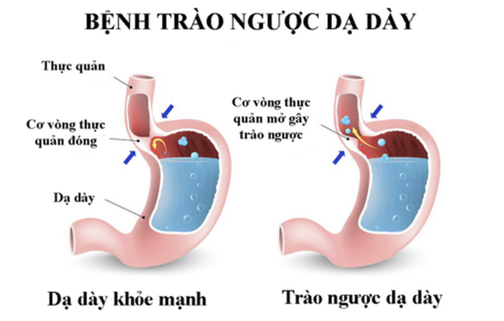 Hình ảnh trào ngược dạ dày - thực quản.