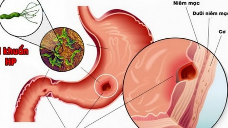 Vi khuẩn Helicobacter pylori - nguyên nhân chính gây loét dạ dày - tá tràng.