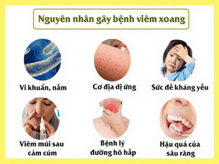Các nguyên nhân gây viêm xoang.