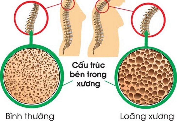 Loãng xương làm biến dạng đường cong sinh lý dẫn đến gù lưng.