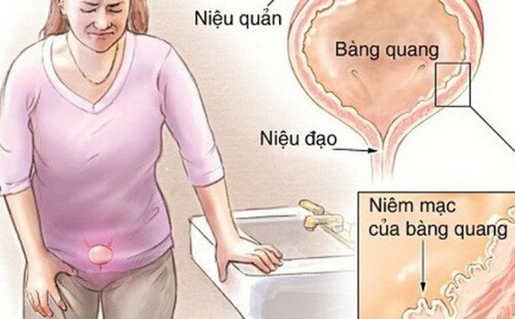 Viêm bàng quang thường gặp ở phụ nữ hơn nam giới.