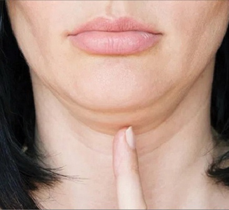 Cằm 2 ngấn khiến gương mặt thiếu thanh thoát.