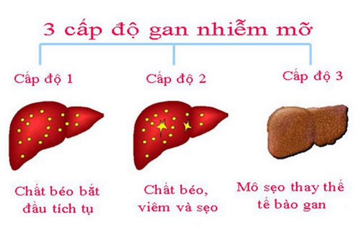 Các cấp độ gan nhiễm mỡ.