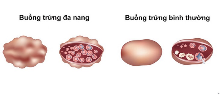Buồng trứng đa nang - một tác hại do dậy thì sớm ở bé gái.