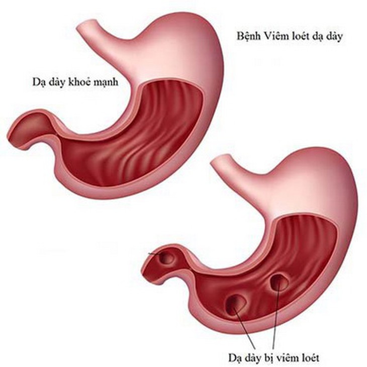 Hình ảnh viêm loét dạ dày.