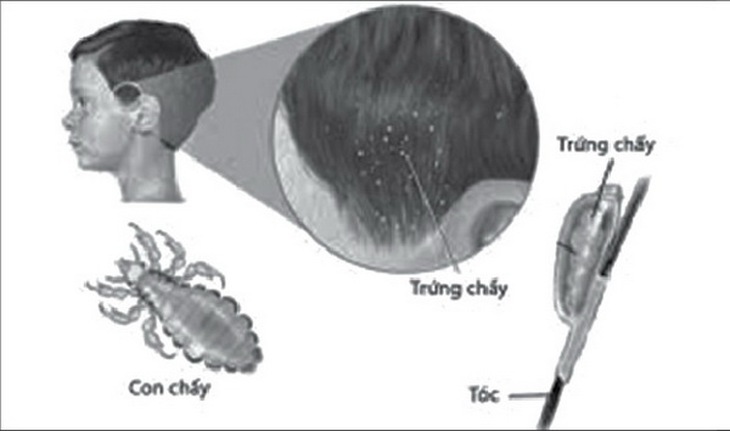 Hình ảnh chấy và trứng chấy.