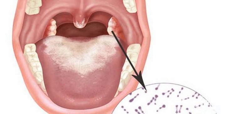 Hình ảnh giả mạc trong bệnh bạch hầu.