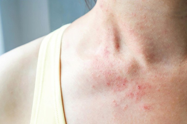Dấu hiệu mắc bệnh Zona (giời leo)