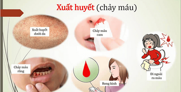 Các mức độ của bệnh sốt xuất huyết.