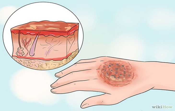 Cách chăm sóc vết bỏng bị vỡ