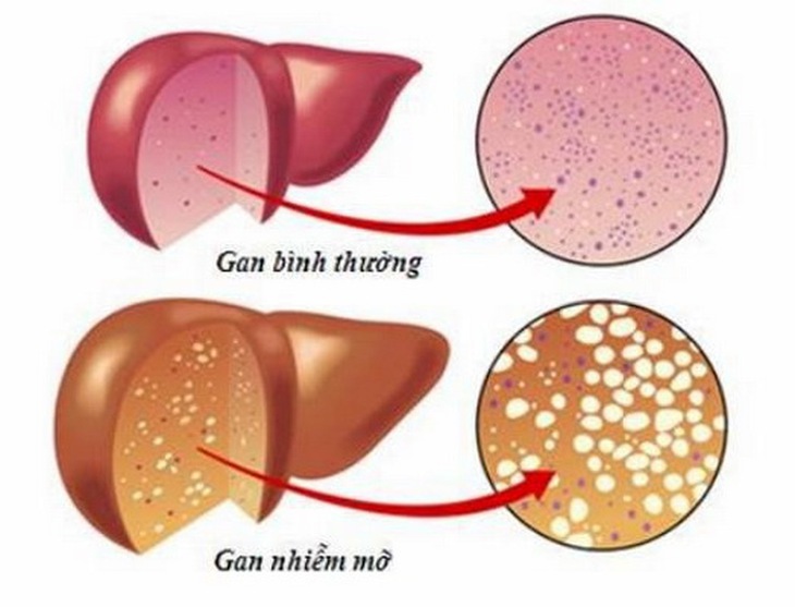 Tình trạng gan nhiễm mỡ có thể cải thiện được qua chế độ ăn và tập luyện.