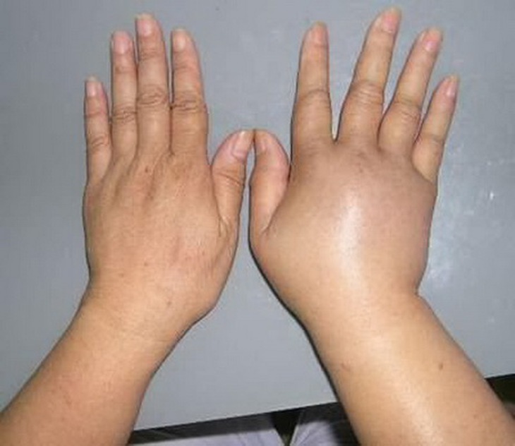 Ăn quá ít muối khiến lượng natri máu giảm, gây hiện tượng phù tay, chân do nước tự do thoát ra ngoài khoảng kẽ.