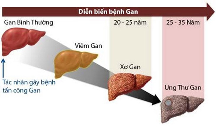 Từ rượu, bia diễn tiến đến xơ gan và ung thư gan.