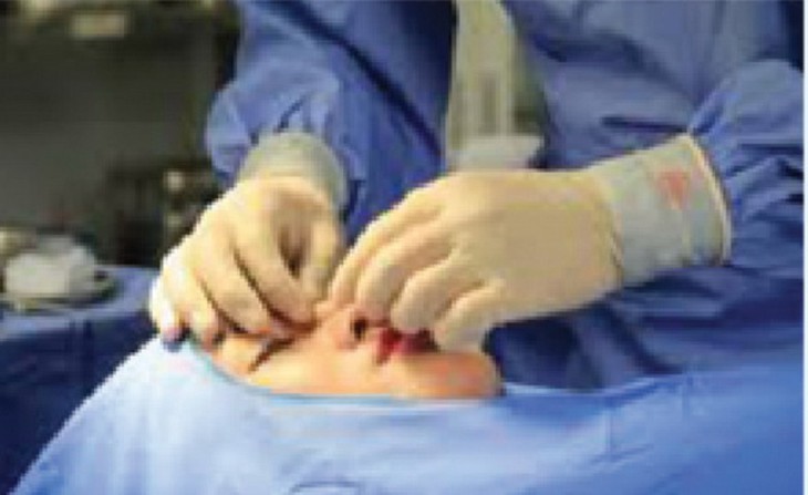 Sau khi nâng mũi nếu thấy bất thường thì cần kiểm tra lại để tìm ra nguyên nhân.