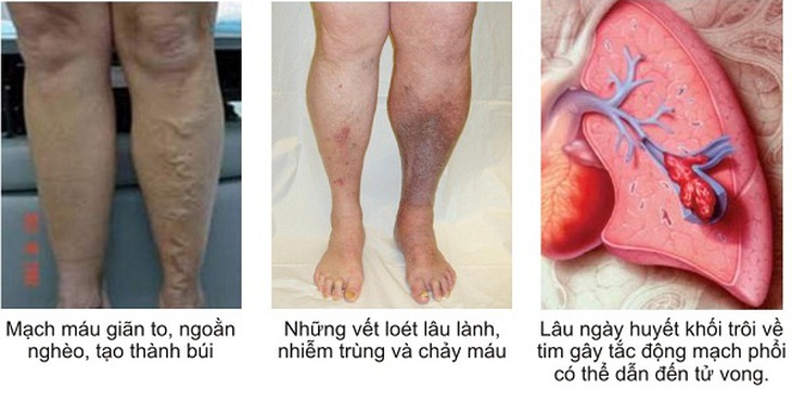Những dấu hiệu nhận biết viêm tắc động mạch.