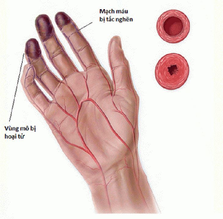 Hình ảnh mạch máu bị tắc nghẽn.