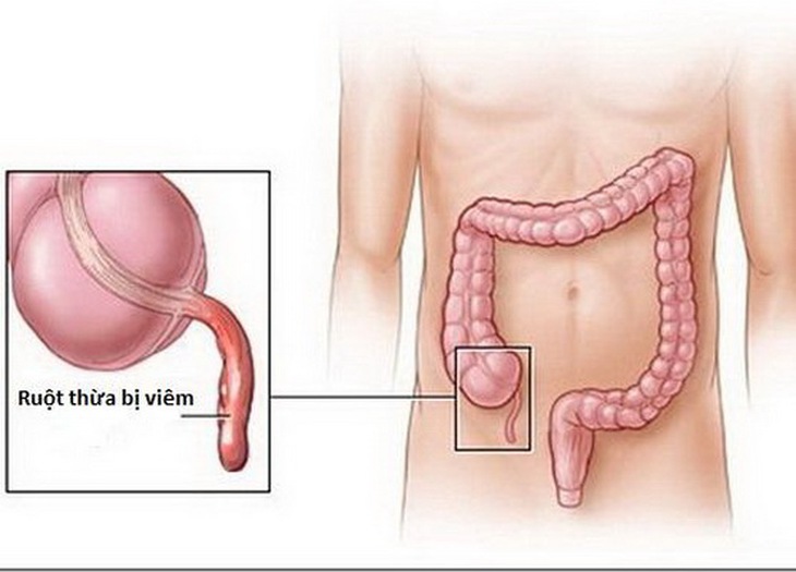 Viêm ruột thừa - một nguyên nhân gây đau bụng ở trẻ.