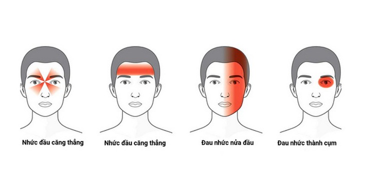 Các  loại bệnh đau đầu phổ biến.