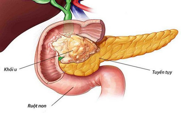 Nang giả tụy là một tổn thương dạng nang hay gặp nhất của tuyến tụy.