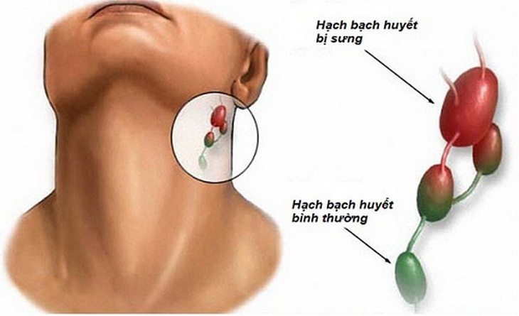 Một số bệnh nhiễm trùng cấp tính thường có hạch xuất hiện gần vùng tổn thương.