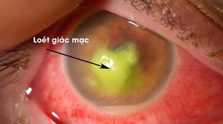 Hình ảnh loét giác mạc.