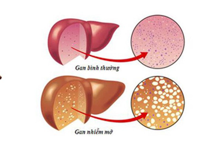 Chuối giúp bảo vệ gan, ngăn cản sự thâm nhiễm mỡ trong gan.