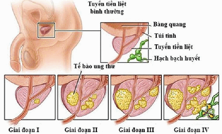 Ung thư TTL nếu được phát hiện và điều trị đúng cách có thể chữa khỏi.