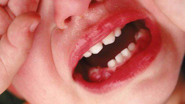 Viêm răng lợi, hôi miệng (Đông y gọi Cam miệng) rất hay gặp ở trẻ nhỏ.