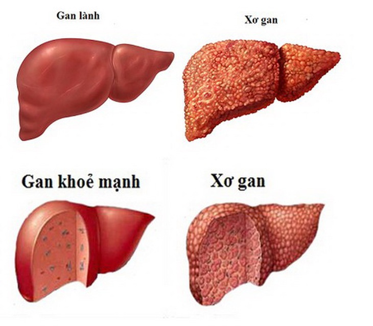 Hình ảnh gan bị xơ.