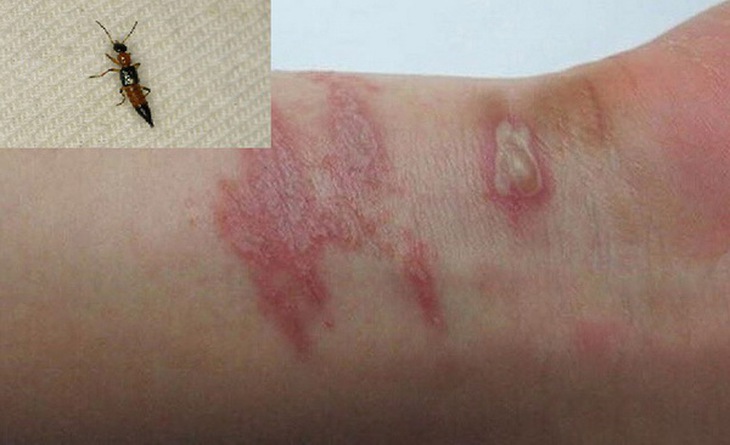 Viêm da tiếp xúc do kiến ba khoang đốt.