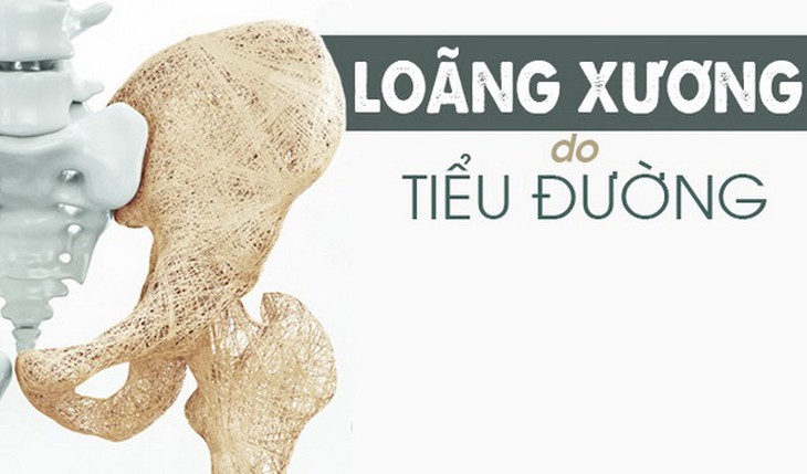 Đái tháo đường gây loãng xương dễ dẫn đến gãy xương.