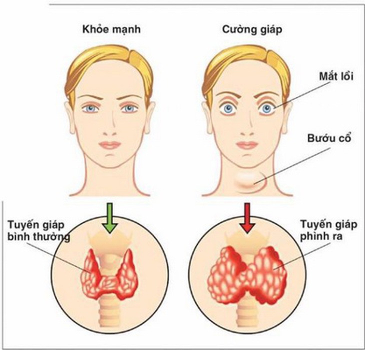 Bệnh cường giáp gây nhiều biến chứng nguy hiểm.