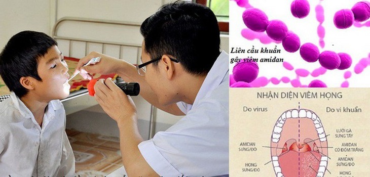 Viêm họng cấp ở trẻ khi chuyển mùa