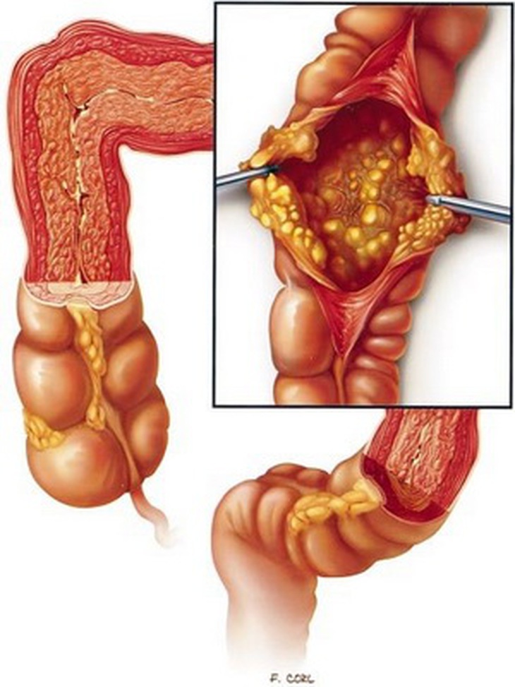 Hình ảnh vi khuẩn lao phá hủy ruột.