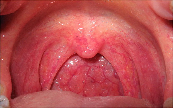 Cát cánh là vị thuốc trị viêm họng rất hiệu quả.