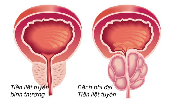 Phì đại TTL ảnh hưởng tới tình dục.