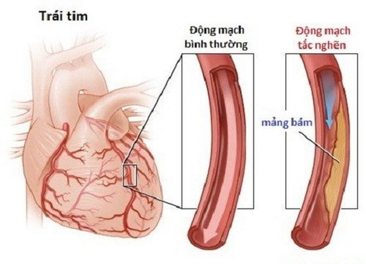 Bệnh mạch vành gây ra bởi các mảng xơ vữa trong lòng động mạch.