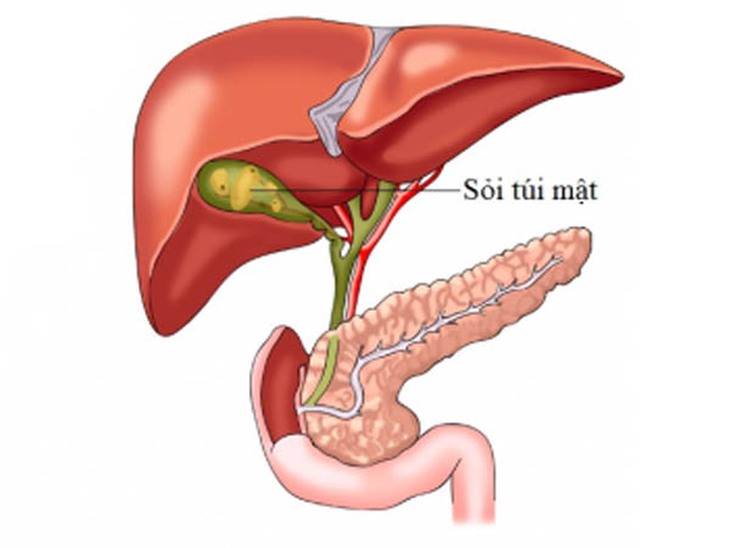 Sỏi túi mật là 1 nguyên nhân gây đau bụng ở người cao tuổi.
