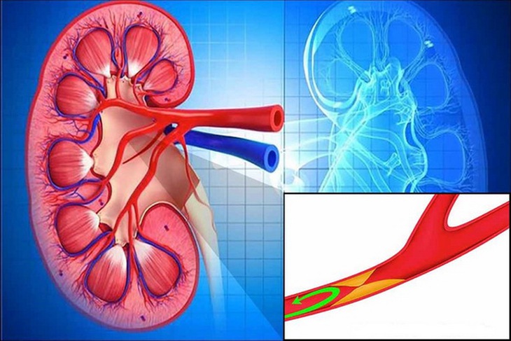 Hình ảnh hẹp động mạch thận.