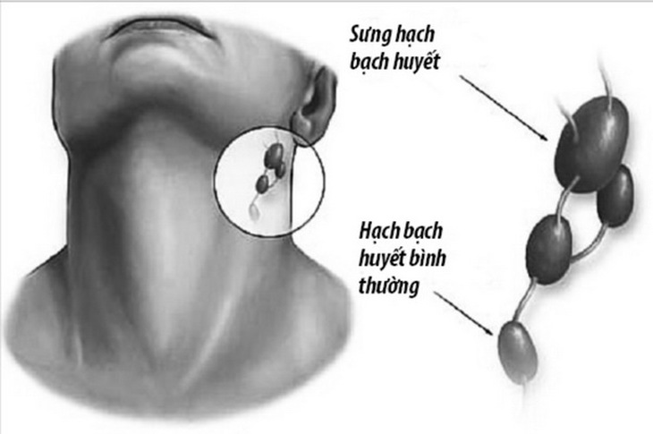 Lao hạch là bệnh không lây cho người xung quanh khi tiếp xúc và dễ điều trị.