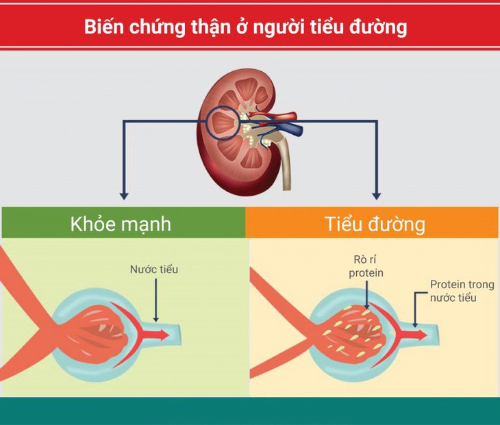 Kiểm soát tốt đường huyết để ngăn ngừa biến chứng thận do đái tháo đường.